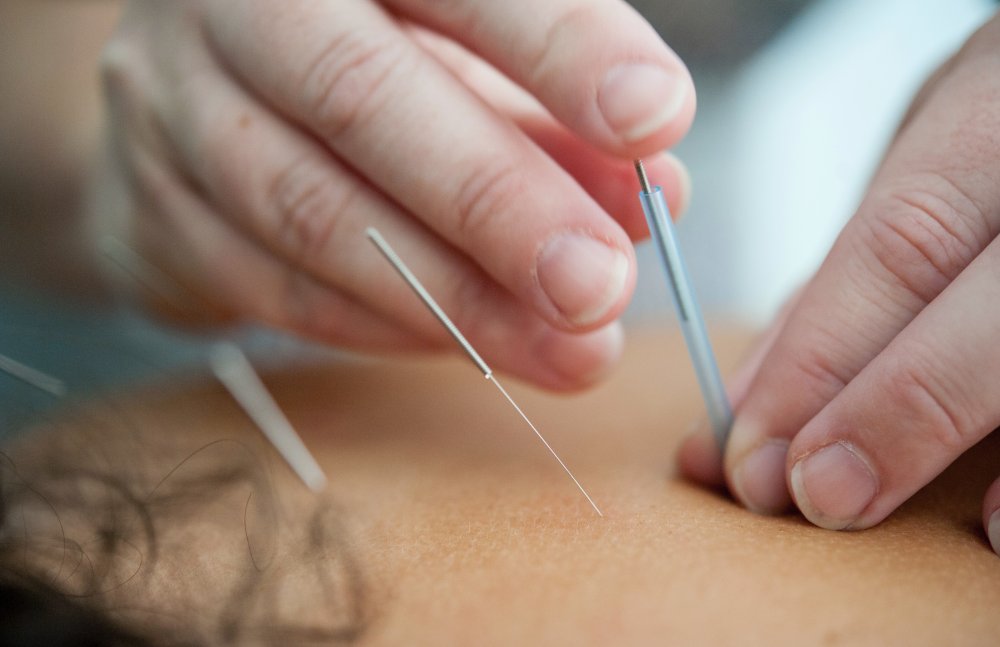 Hvorfor skal jeg vælge akupunktur?